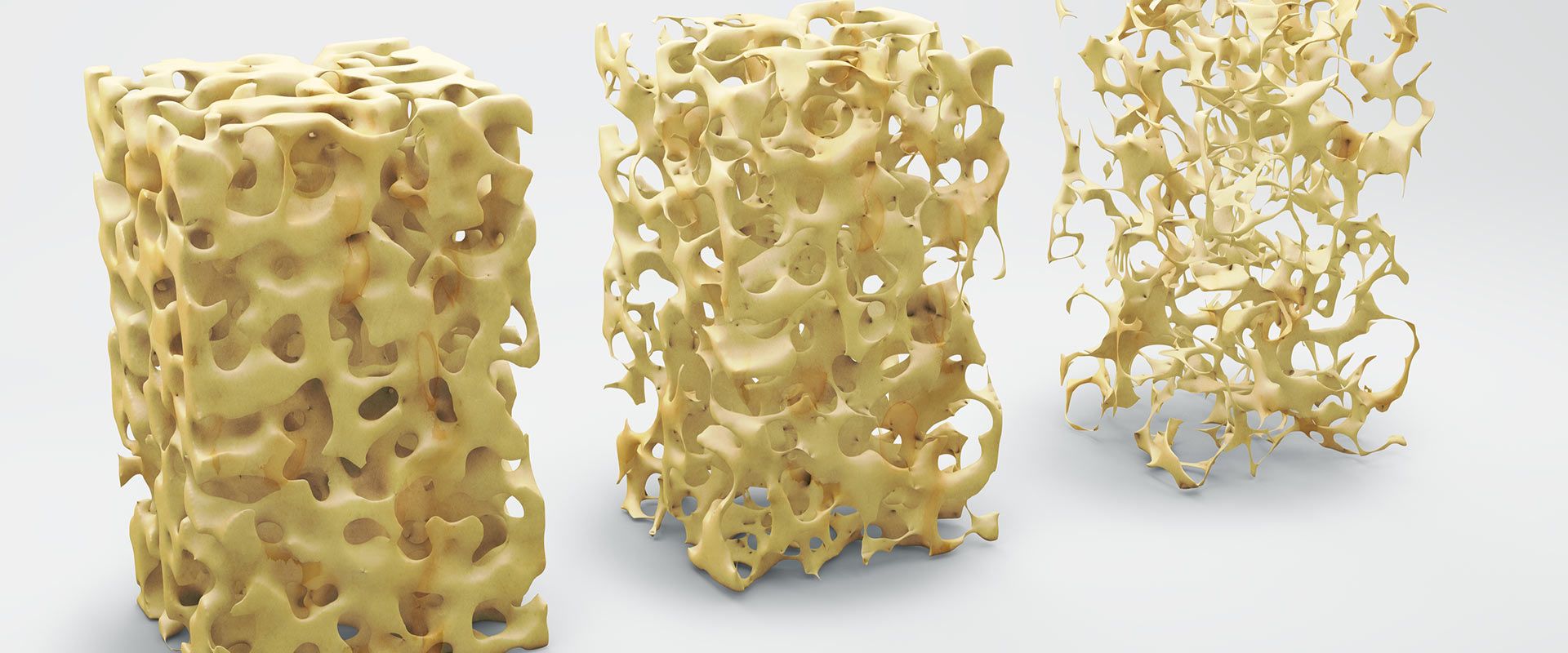 Bild mit Knochengewebe als Beispiel für Osteoporose